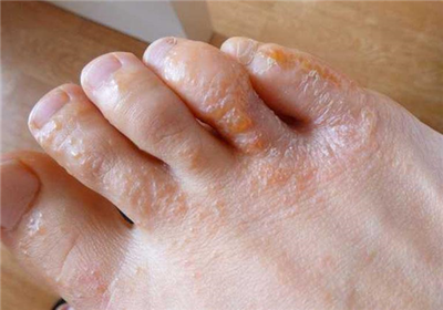 Bệnh tổ đỉa lòng bàn chân có triệu chứng như thế nào?